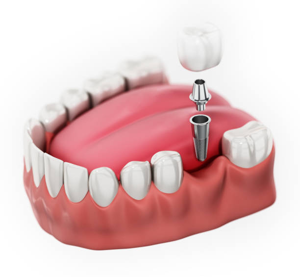 Dental Implants for Single Tooth: Understanding the Recovery Process